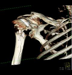 Metal Reduction for Shoulder Replacement - CTisus CT Scan