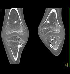 Pins and Screws in Tibia and Fibula for Reconstructive Surgery - CTisus CT Scan