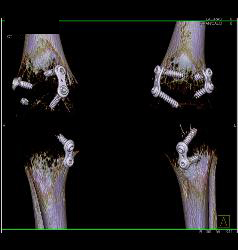 Pins and Screws in Tibia and Fibula for Reconstructive Surgery - CTisus CT Scan