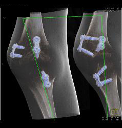 Pins and Screws in Tibia and Fibula for Reconstructive Surgery - CTisus CT Scan