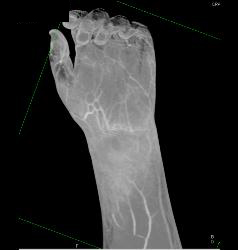 Cellulitis With Abscess - CTisus CT Scan