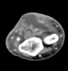 Cellulitis With Abscess - CTisus CT Scan