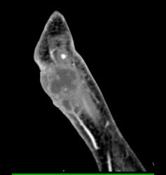 Cellulitis With Abscess - CTisus CT Scan