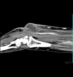 Cellulitis With Abscess - CTisus CT Scan