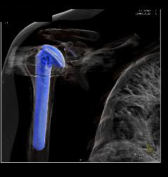 Total Shoulder Replacement - CTisus CT Scan