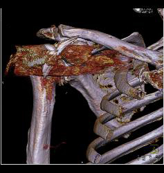 Total Shoulder Replacement - CTisus CT Scan