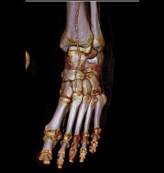 Foot Ulcer With Increased Blood Flow - CTisus CT Scan