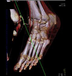 Foot Ulcer With Increased Blood Flow - CTisus CT Scan