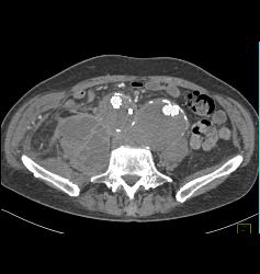 Iliac Artery Aneurysms With Iliopsoas Abscess and Bleed - CTisus CT Scan