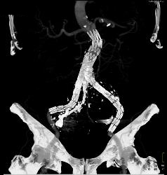 Iliac Artery Aneurysms With Iliopsoas Abscess and Bleed - CTisus CT Scan