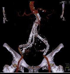 Iliac Artery Aneurysms With Iliopsoas Abscess and Bleed - CTisus CT Scan