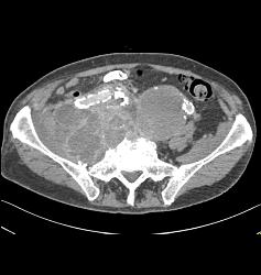 Iliac Artery Aneurysms With Iliopsoas Abscess and Bleed - CTisus CT Scan