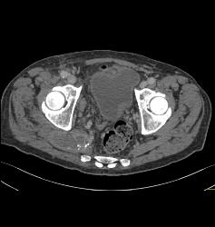 Iliac Artery Aneurysms With Iliopsoas Abscess and Bleed - CTisus CT Scan