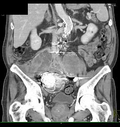 Iliac Artery Aneurysms With Iliopsoas Abscess and Bleed - CTisus CT Scan