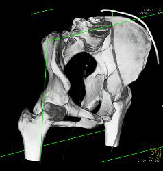 Acetabular Fracture With Pelvic Hematoma - CTisus CT Scan