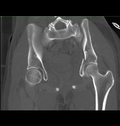 Acetabular Fracture With Pelvic Hematoma - CTisus CT Scan