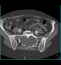 Marfan Syndrome - CTisus CT Scan