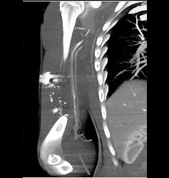 GSW With Fracture and Spasm in Brachial Artery - CTisus CT Scan