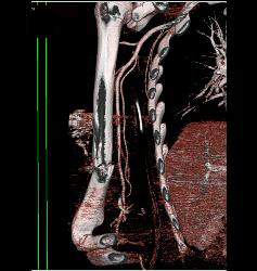 GSW With Fracture and Spasm in Brachial Artery - CTisus CT Scan