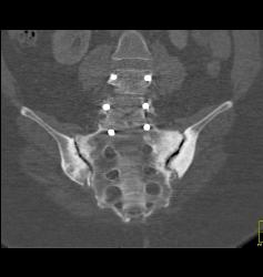 Sacro-ilietis Bilaterally - CTisus CT Scan