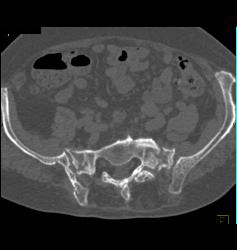 Stress Fracture in Sacrum - CTisus CT Scan