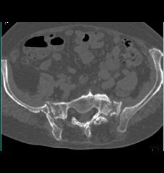 Stress Fracture in Sacrum - CTisus CT Scan