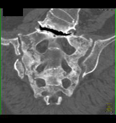 Stress Fracture in Sacrum - CTisus CT Scan