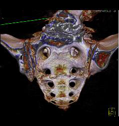 Stress Fracture in Sacrum - CTisus CT Scan