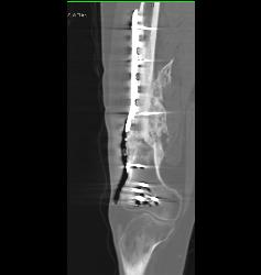 Nonunion Femur - CTisus CT Scan