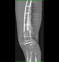 Nonunion Femur - CTisus CT Scan