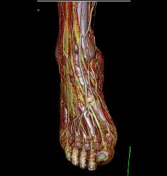 Vasacular Mapping of Foot in 3D - CTisus CT Scan