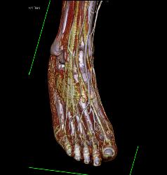 Vasacular Mapping of Foot in 3D - CTisus CT Scan