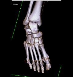 Vasacular Mapping of Foot in 3D - CTisus CT Scan