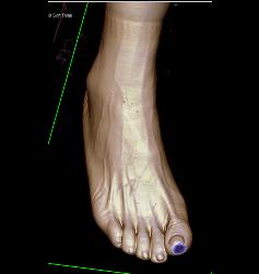 Vasacular Mapping of Foot in 3D - CTisus CT Scan