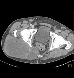 Liposarcoma - CTisus CT Scan