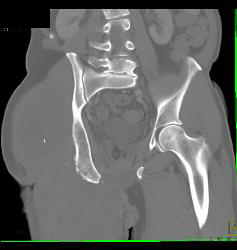 Liposarcoma - CTisus CT Scan