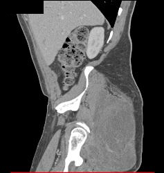 Liposarcoma - CTisus CT Scan