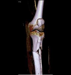 Spiral Fractures of Tibia and Fibula - CTisus CT Scan