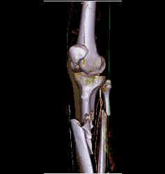 Spiral Fractures of Tibia and Fibula - CTisus CT Scan