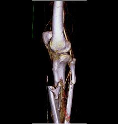 Spiral Fractures of Tibia and Fibula - CTisus CT Scan