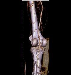 Spiral Fractures of Tibia and Fibula - CTisus CT Scan