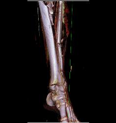 Spiral Fractures of Tibia and Fibula - CTisus CT Scan