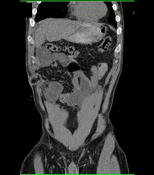 Abdominal Wall Abscess - CTisus CT Scan