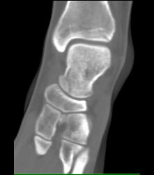 Talus Fracture in A Range of Perspectives and Renderings - CTisus CT Scan