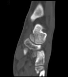 Talus Fracture in A Range of Perspectives and Renderings - CTisus CT Scan