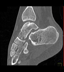 Talus Fracture in A Range of Perspectives and Renderings - CTisus CT Scan