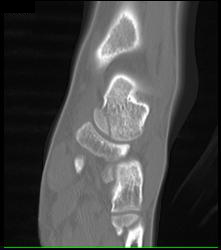 Talus Fracture in A Range of Perspectives and Renderings - CTisus CT Scan