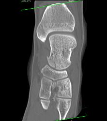 Talus Fracture in A Range of Perspectives and Renderings - CTisus CT Scan