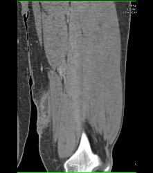 Abscess Thigh - CTisus CT Scan