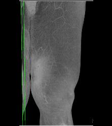 Abscess Thigh - CTisus CT Scan